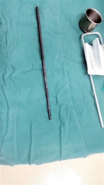 2岁男童摔倒筷子插入口腔12厘米  离颈动脉鞘仅为2毫米 - 长沙新闻网