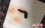 49岁男子鼻腔频繁出血 就诊取出5厘米长蚂蝗(图) - 长沙新闻网