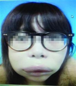 27日，沈阳28岁的媛媛接受“上门服务”的玻尿酸注射后，嘴和脸肿了起来。院方供图 - 长沙新闻网