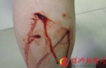 一名女子的左小腿被严重咬伤，缝了三四针（受访者 供图） - 新浪湖南