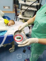 郴州一3岁男孩误吞电池 医师联手急救 - 新浪湖南