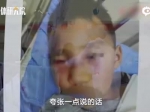 长沙5岁男孩挖鼻孔导致脸肿似奥特曼！医生紧急提醒… - 新浪湖南