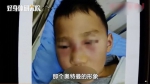 长沙5岁男孩挖鼻孔导致脸肿似奥特曼！医生紧急提醒… - 新浪湖南